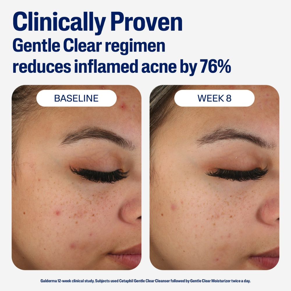 cetaphil mattifying acne moisturizer 89 ml - 2