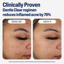 cetaphil mattifying acne moisturizer 89 ml - 2
